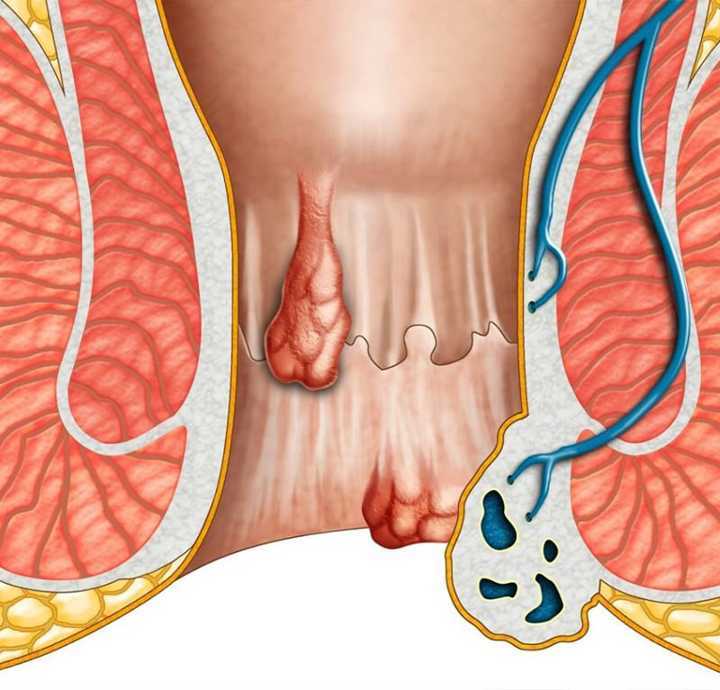 Piles Fistula