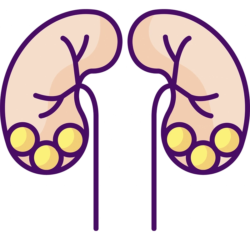 Kidney Stone